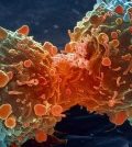 Curcumin Proven to ELIMINATE Stage-3 Myeloma Cancer | www.curcuminhealth.info