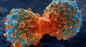 Curcumin Proven to ELIMINATE Stage-3 Myeloma Cancer | www.curcuminhealth.info